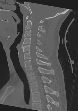 Cervical Intercalary Bone Radiology Case Radiopaedia Org