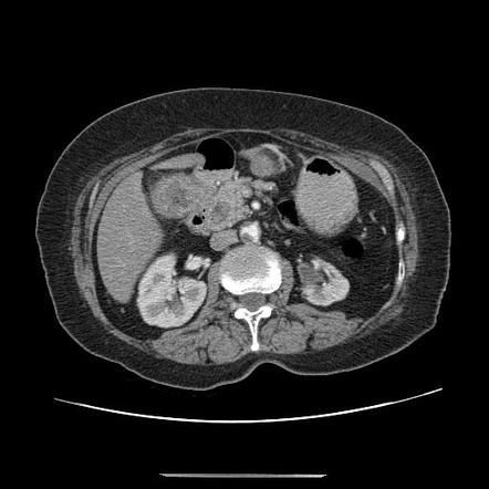 Cholecystoduodenal fistula | Radiology Case | Radiopaedia.org