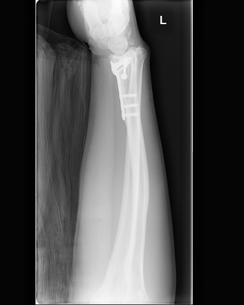 Essex-Lopresti fracture-dislocation | Image | Radiopaedia.org