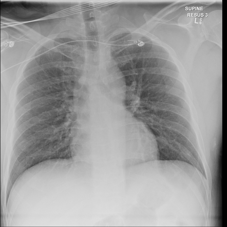 Deep sulcus sign (chest) | Radiology Reference Article | Radiopaedia.org