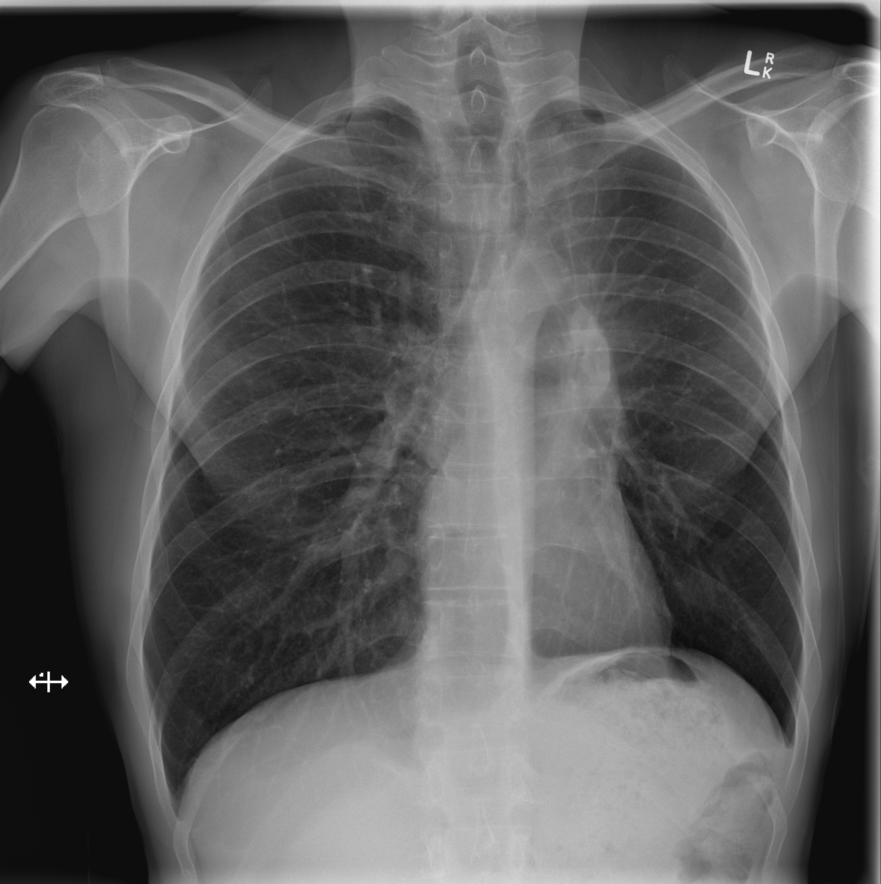 Lung Collapse Chest X Ray