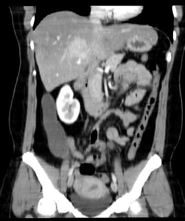 Appendiceal Mucocele | Radiology Case | Radiopaedia.org