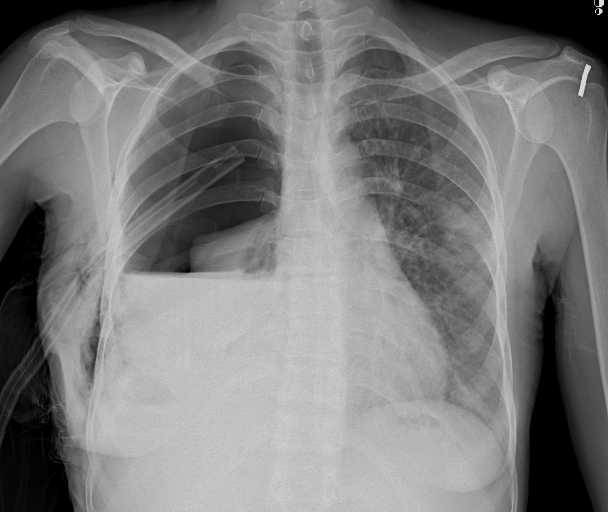 Tension hydropneumothorax | Image | Radiopaedia.org