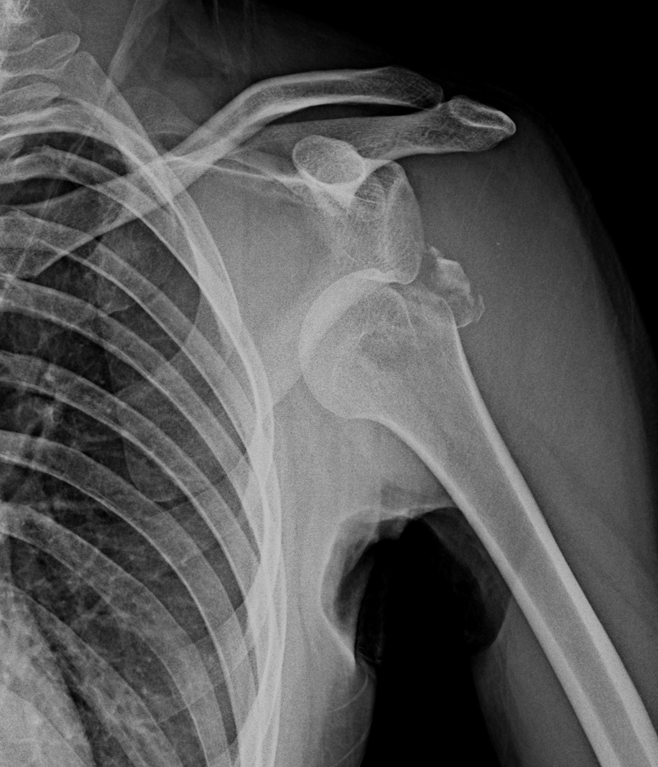 All 101+ Images Pictures Of A Dislocated Shoulder Stunning