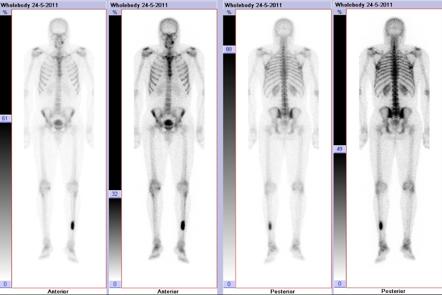 radiopaedia bone