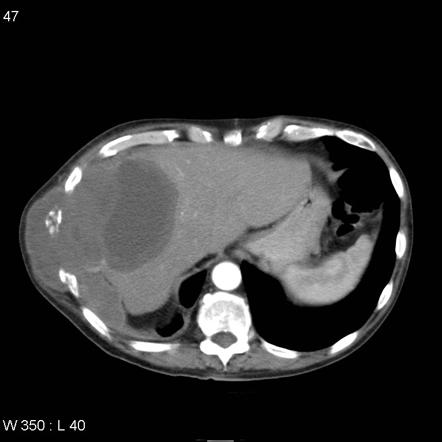 Mesothelioma | Radiology Case | Radiopaedia.org