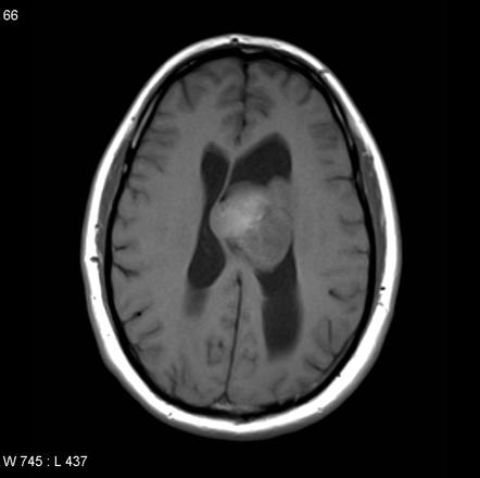 Glioblastoma NOS (extending into ventricle) | Radiology Case ...