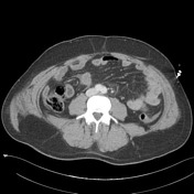 Free Intraperitoneal Fluid Summary Radiology Reference Article Radiopaedia Org