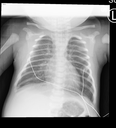 Egg On A String Sign Heart Radiology Reference Article Radiopaedia Org