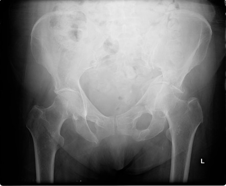 Acetabular fracture | Radiology Case | Radiopaedia.org