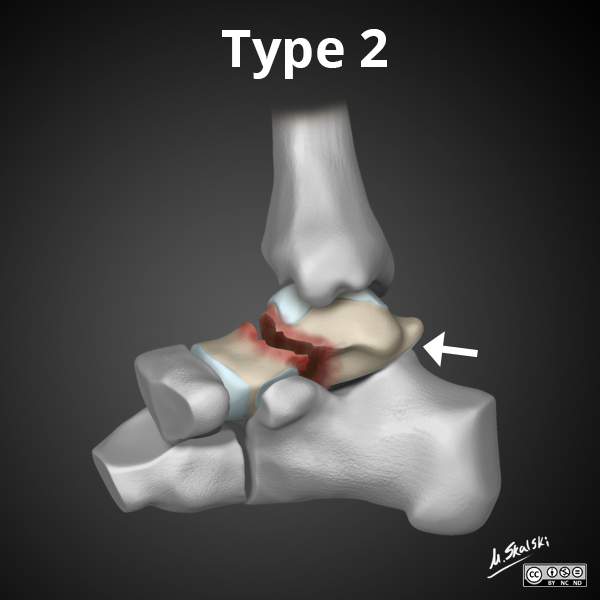 Hawkins classification of talar neck fracture - illustration | Image ...