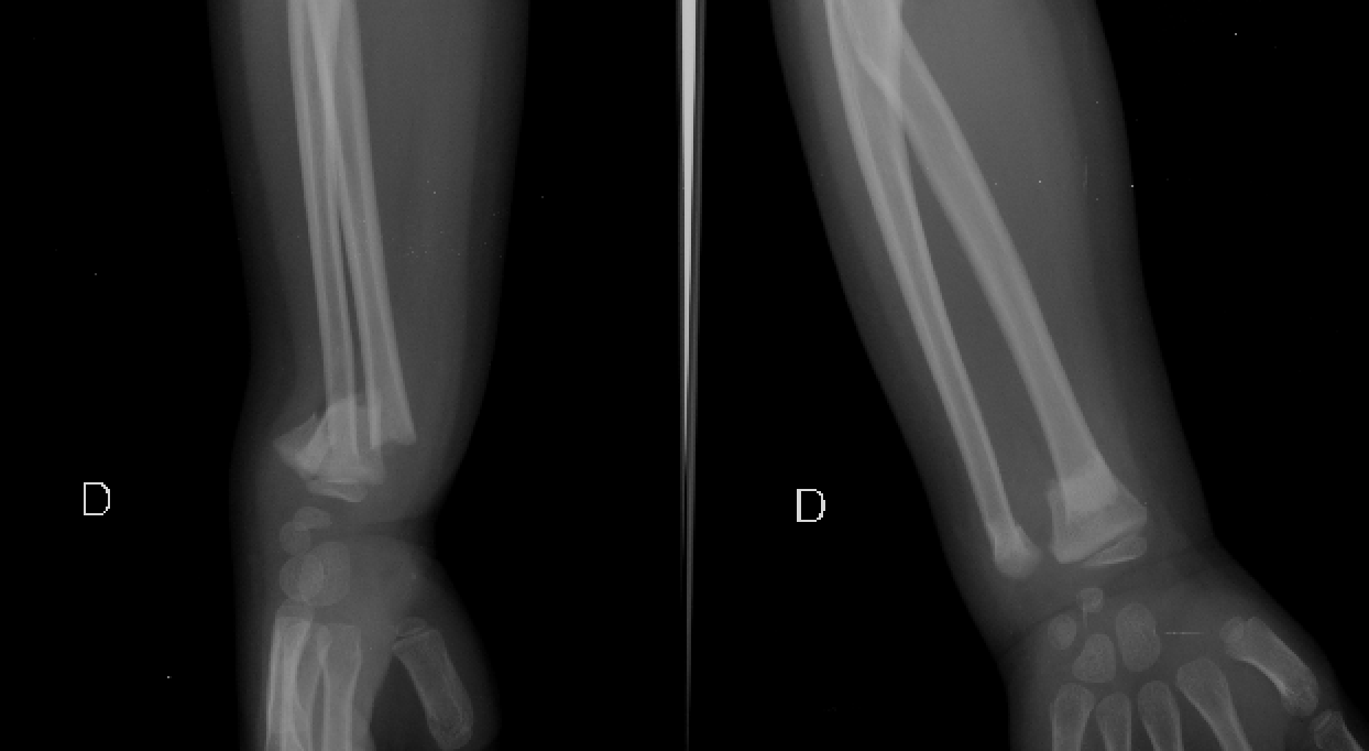 icd 10 code for right distal radius and ulna fracture