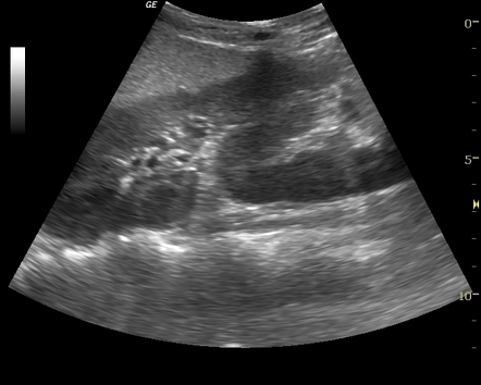 Crossed fused renal ectopia | Radiology Case | Radiopaedia.org