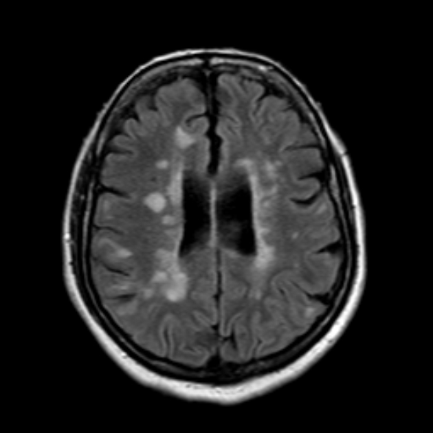 Multiple sclerosis - black holes | Image | Radiopaedia.org