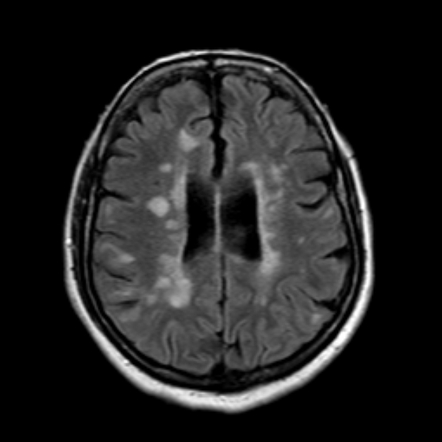 Multiple sclerosis - black holes | Image | Radiopaedia.org