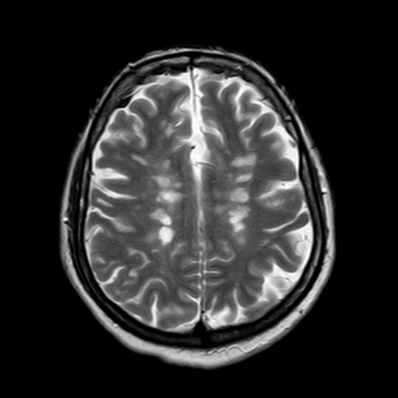 Multiple sclerosis - black holes | Image | Radiopaedia.org