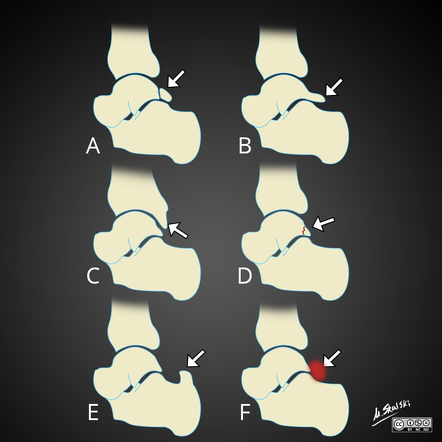 Posterior Ankle Impingement - Illustration Of Causes | Radiology Case ...