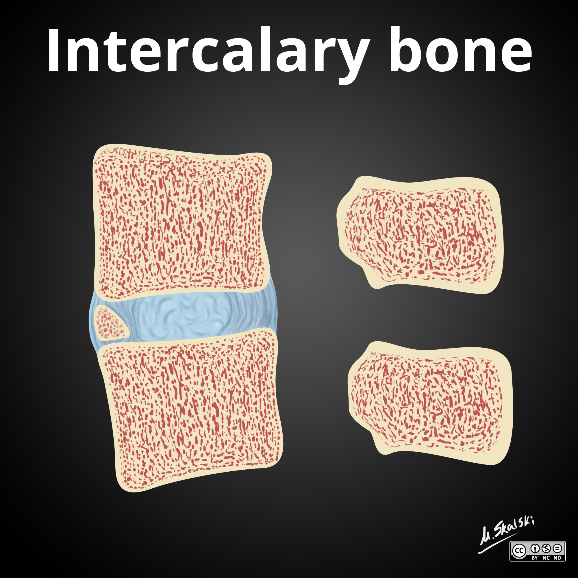 Limbus Vertebra Vs Intercalary Bone Illustration Image 6467