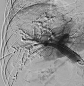 Portal vein embolization | Radiology Reference Article | Radiopaedia.org