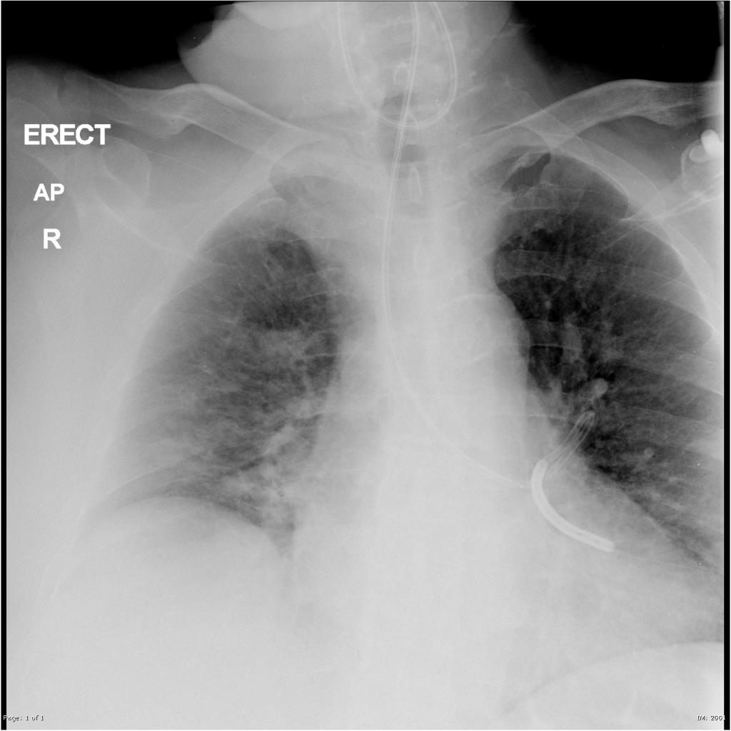 Nasogastric Tube In Bronchus Radiology Case Radiopaedia Org