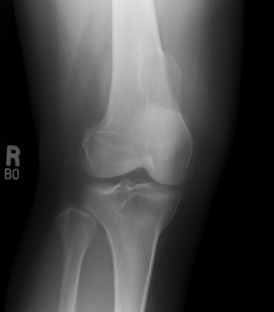 Osteochondroma - sessile | Image | Radiopaedia.org