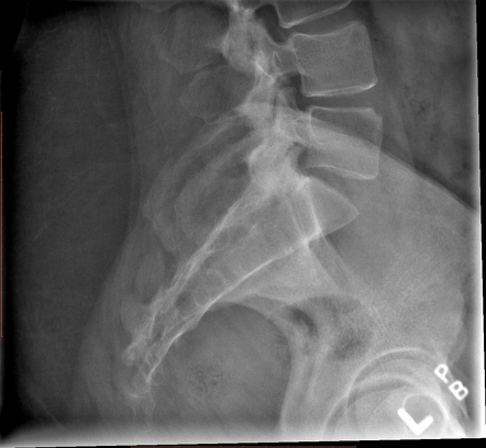 Ankylosing Spondylitis Image Radiopaedia Org