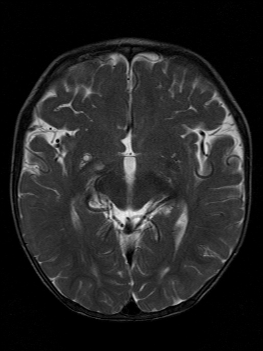 Occipital Horn Syndrome Image 5918