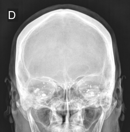 Remnants from myelography contrast | Radiology Case | Radiopaedia.org