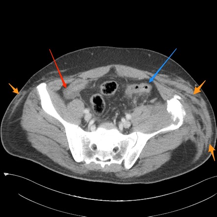 Traumatic bowel injury | Radiology Case | Radiopaedia.org