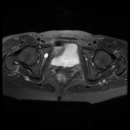 Obturator entrapment neuropathy | Radiology Case | Radiopaedia.org