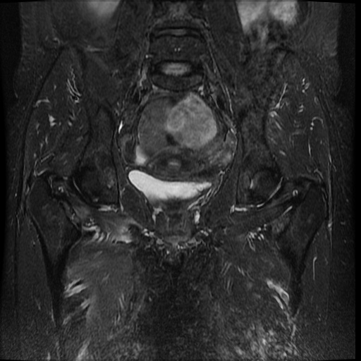 Obturator entrapment neuropathy | Image | Radiopaedia.org