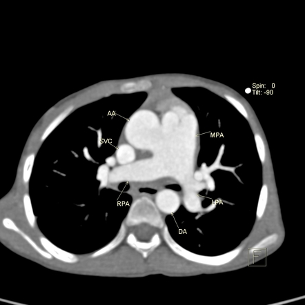 Aortopulmonary window, interrupted aortic arch and large PDA giving the ...