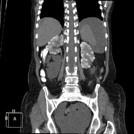 Cortical Nephrocalcinosis | Radiology Reference Article | Radiopaedia.org