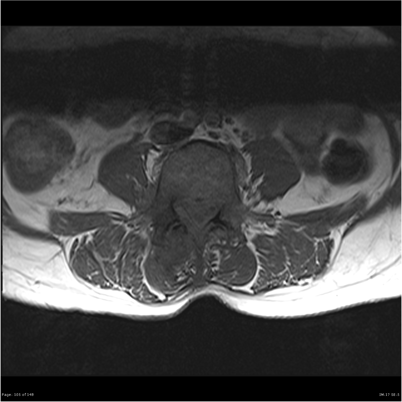 Epidural abscess and facet joint septic arthritis | Image | Radiopaedia.org