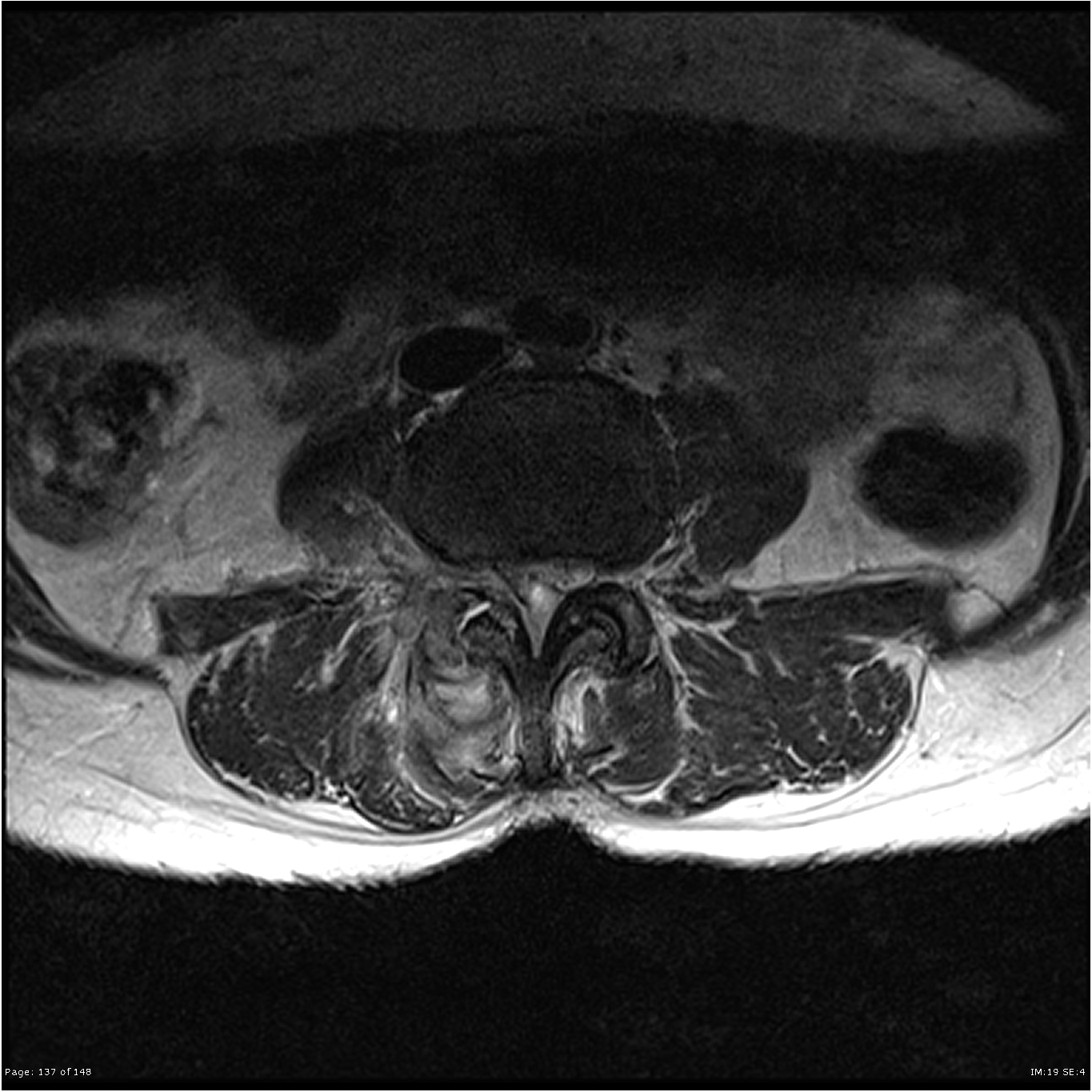 Epidural abscess and facet joint septic arthritis | Image | Radiopaedia.org