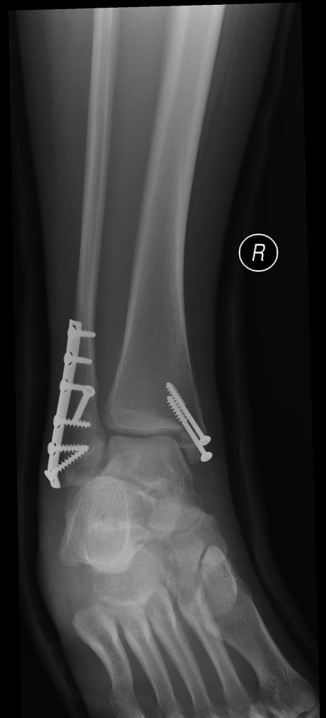 Bimalleolar soft tissue swelling