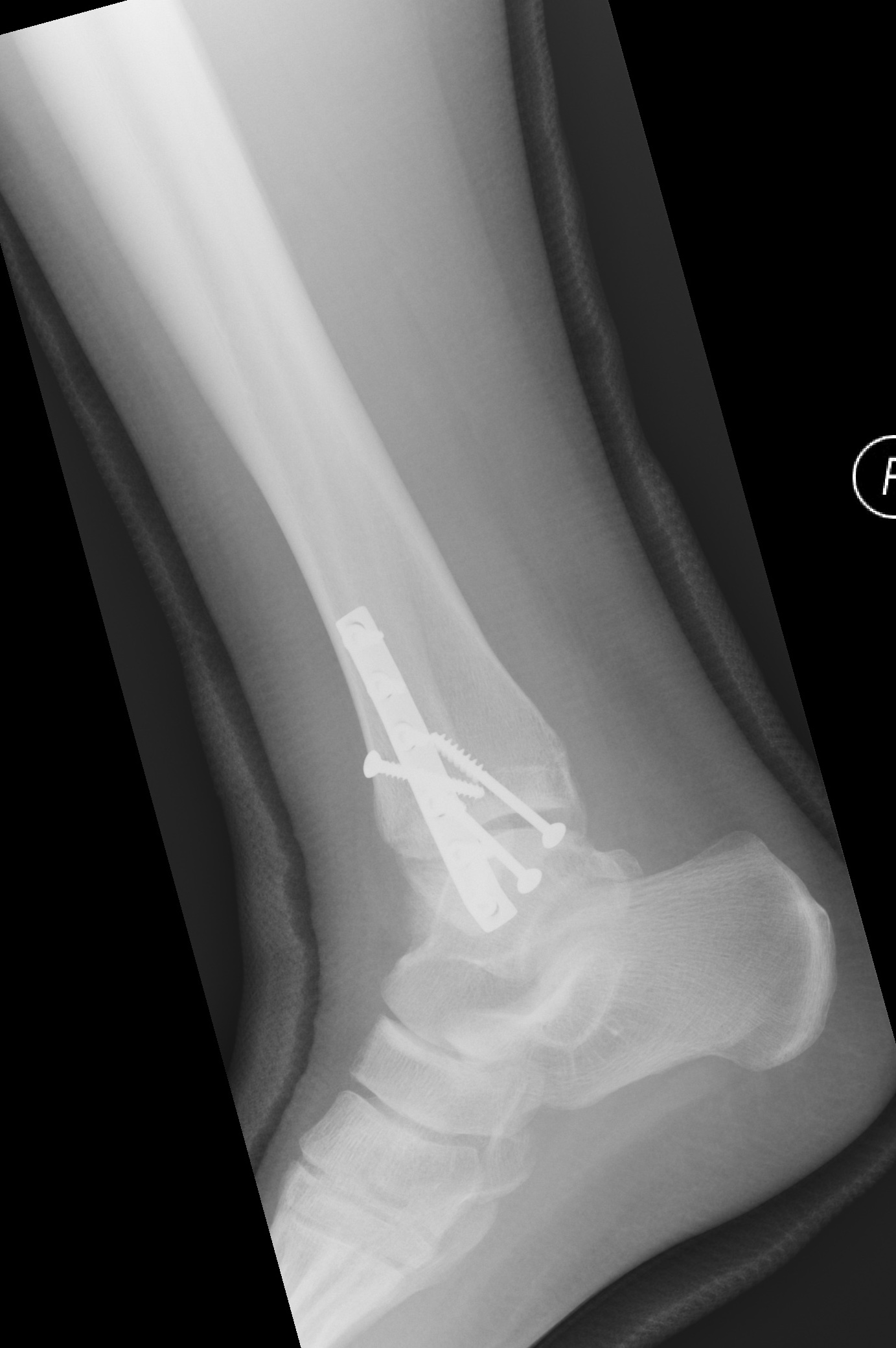 Bimalleolar Ankle Fracture Image