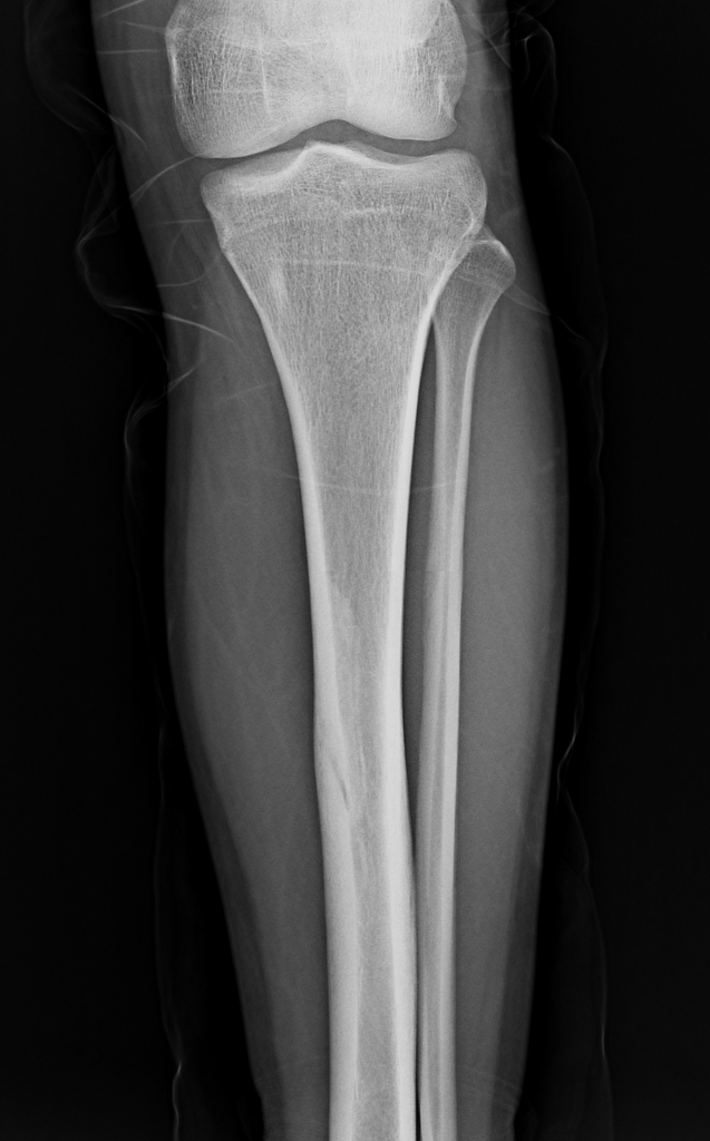 Tibial Stress Fracture Radiology Case Radiopaedia Org