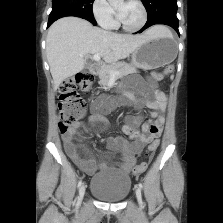 Internal Hernia Radiology Reference Article Radiopaedia Org