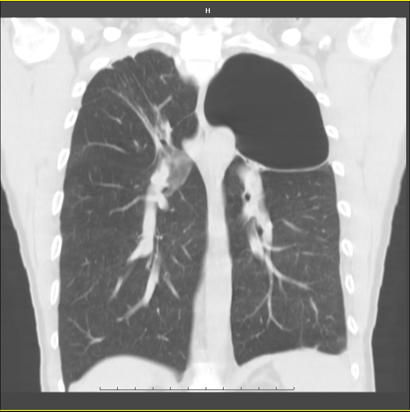 Giant apical bulla | Image | Radiopaedia.org