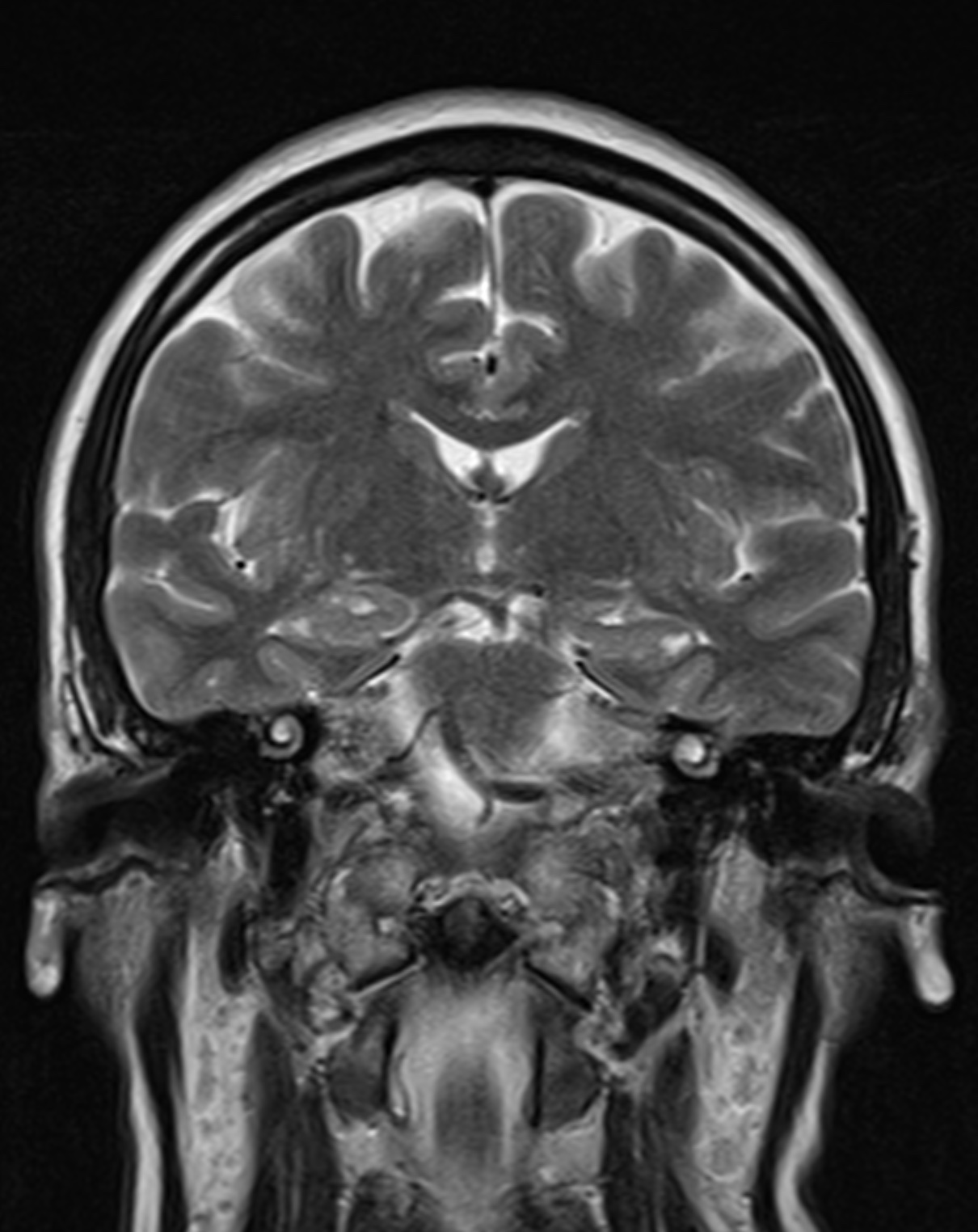 Hippocampal Sulcus