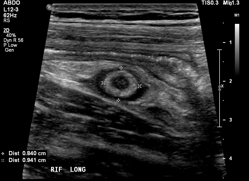 На узи видно аппендицит. Воспаление червеобразного отростка УЗИ. УЗИ червеобразного отростка протокол. Воспаленный аппендикс на УЗИ. Симптом мишени острый аппендицит УЗИ.