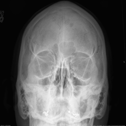 Caldwell view | Radiology Case | Radiopaedia.org