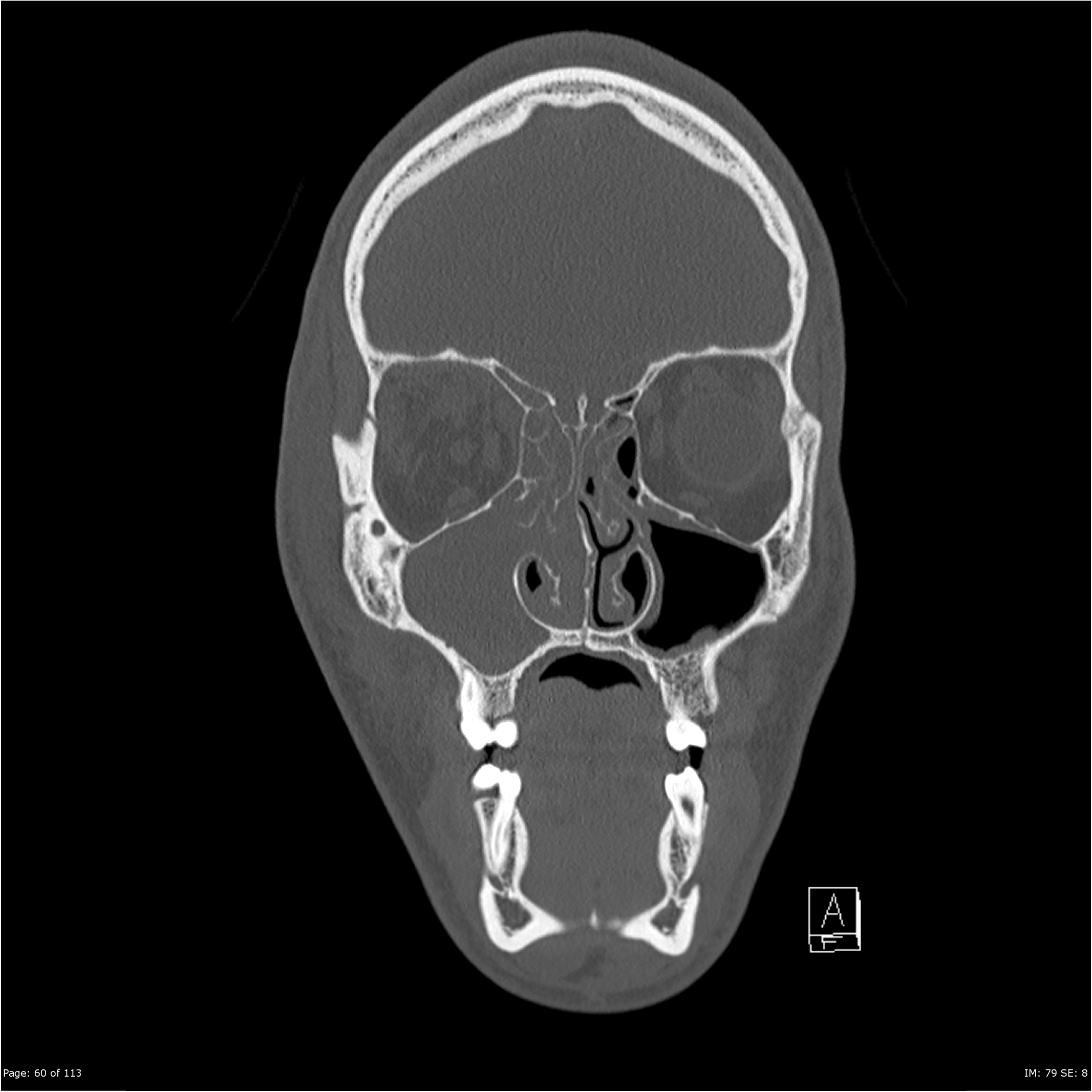 Extradural and orbital abscess | Image | Radiopaedia.org