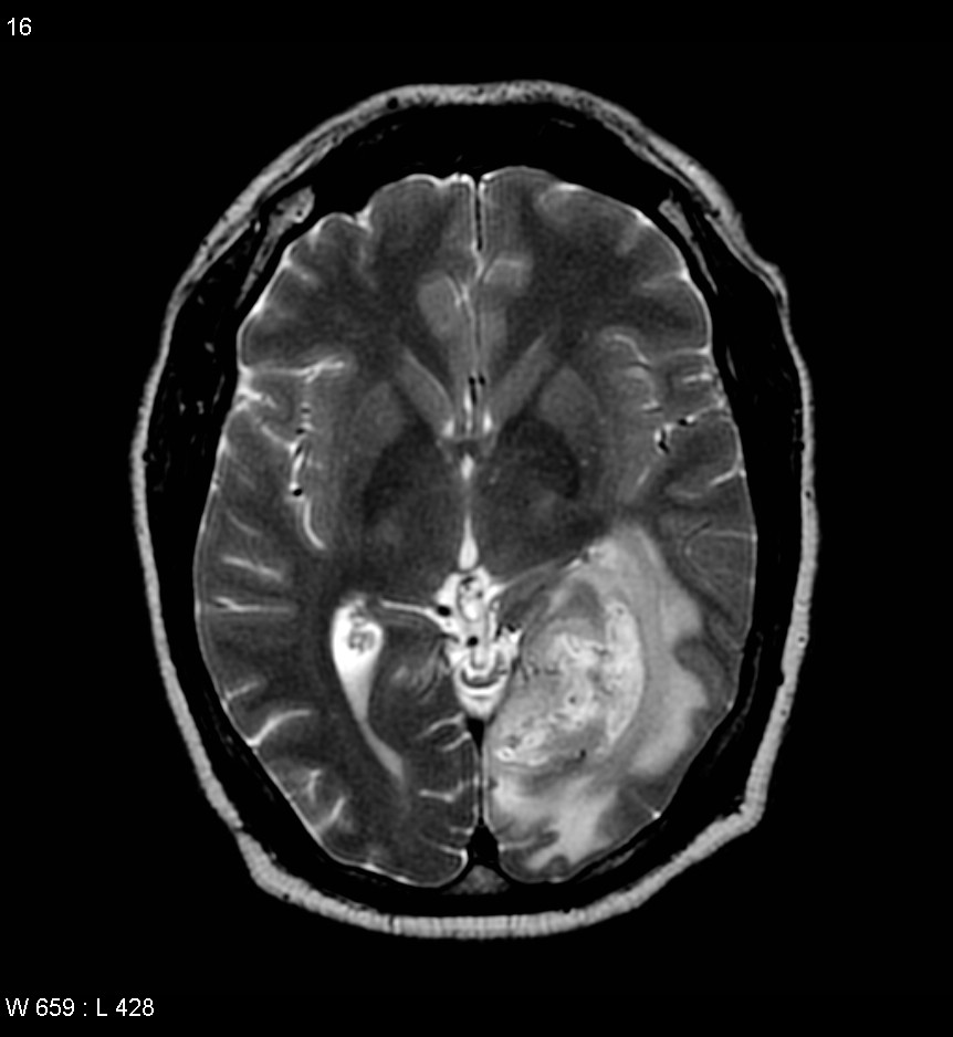 grade iv astrocytoma glioblastoma