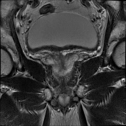 Prostate carcinoma | Image | Radiopaedia.org