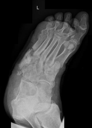 Chronic osteomyelitis - foot | Radiology Case | Radiopaedia.org