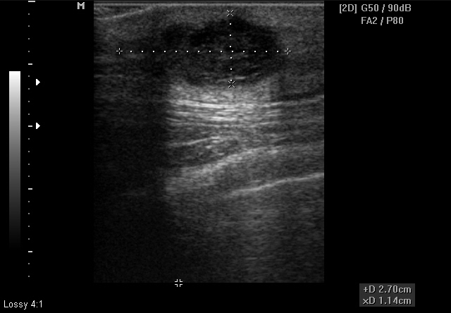 Sebaceous Cyst 