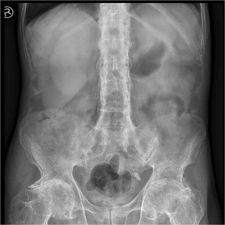 Ankylosing spondylitis | Radiology Case | Radiopaedia.org