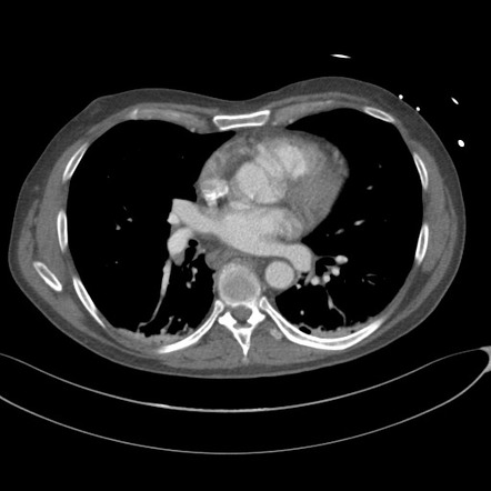 Liver and colon lacerations from stabbing | Radiology Case ...